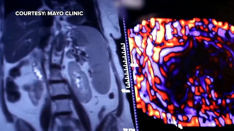 Healthy SA: Battling liver cancer, a disease which often has no symptoms early on — KENS 5 (San Antonio), Valley City Health news